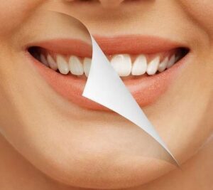 Scaling & Polishing by Aura Skin care and Dental Clinic explained by Dr. Falguni Patel