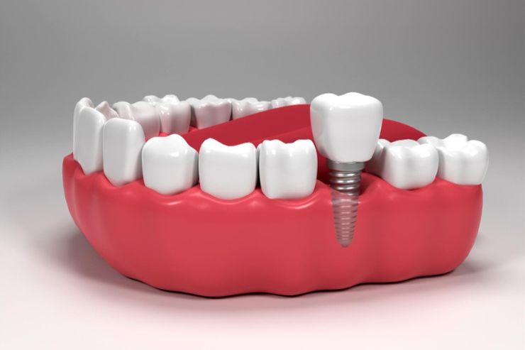 Dental-Implants.jpg